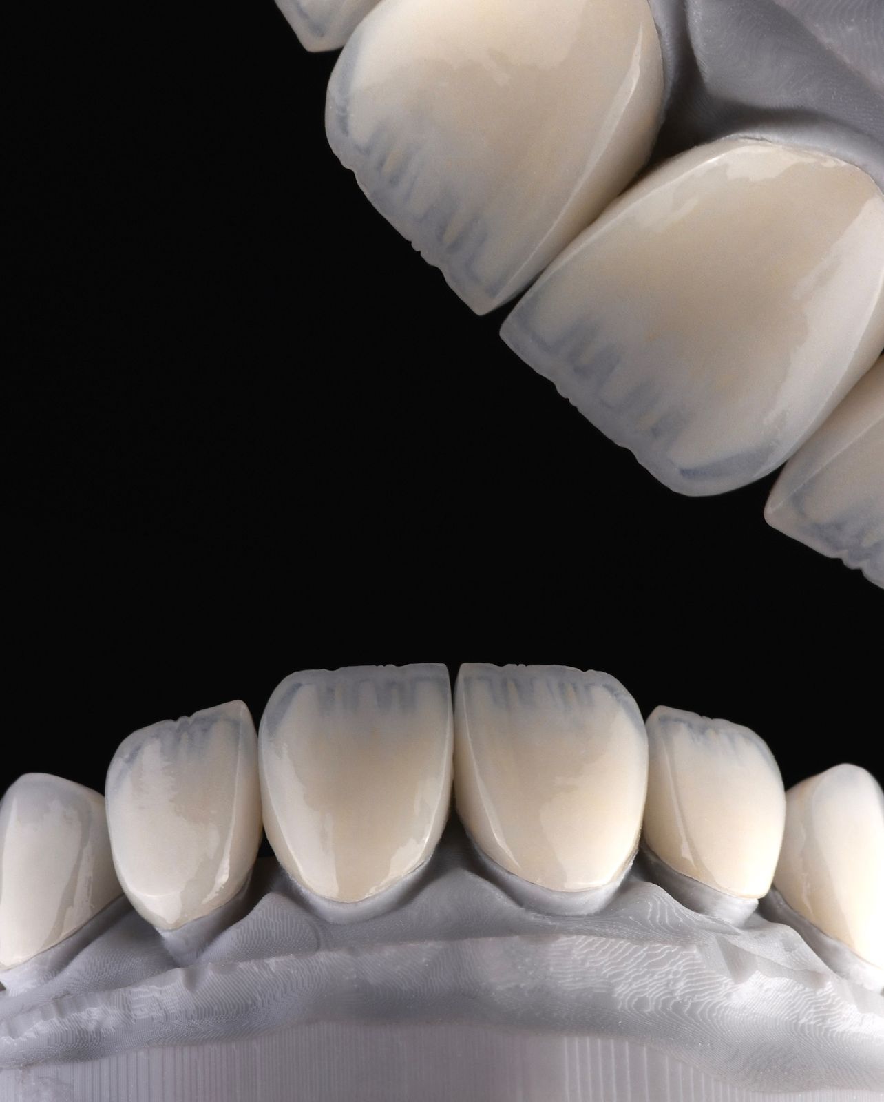 Incisal edge translucency study at Sari's Clinic