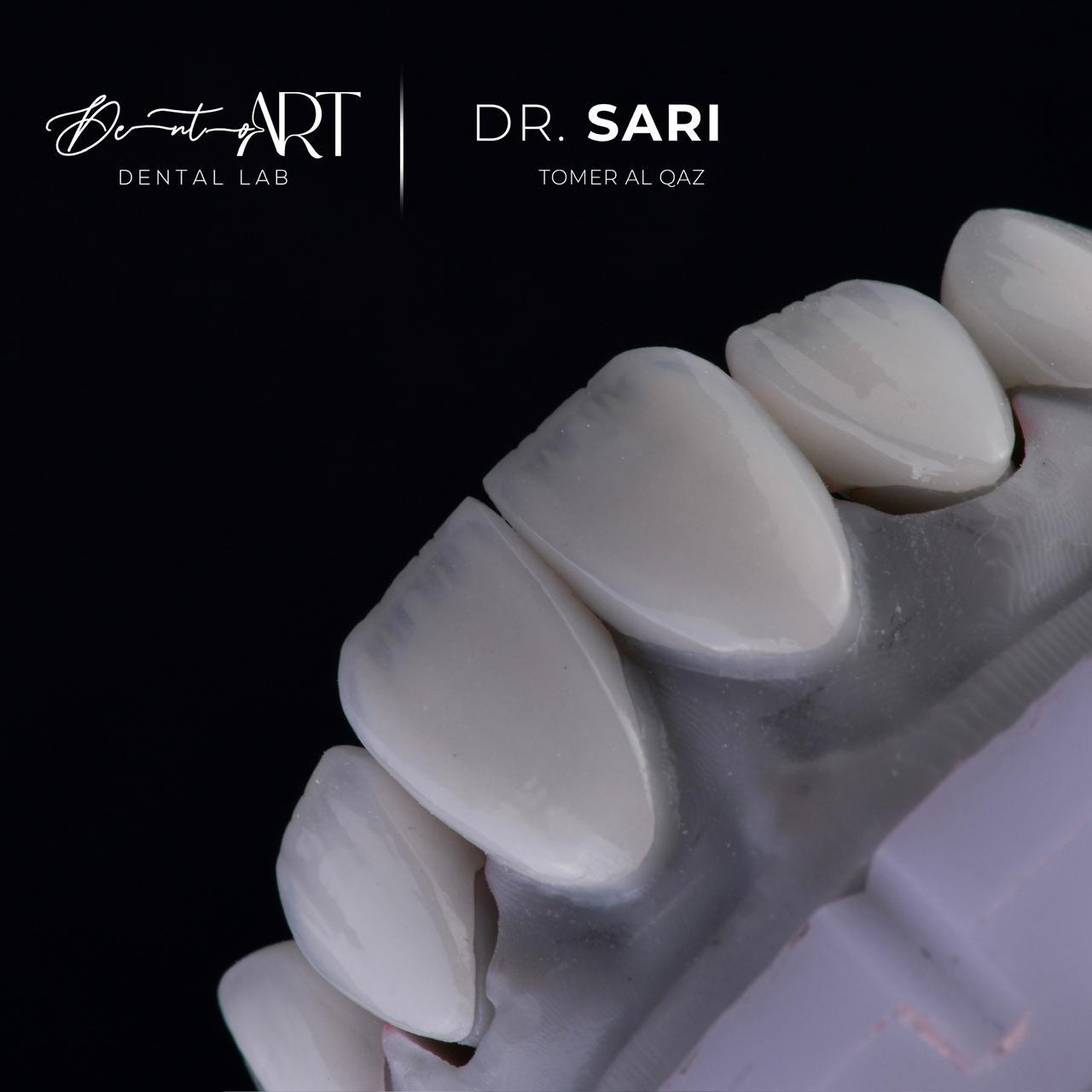 Veneer laboratory case at Sari's Clinic