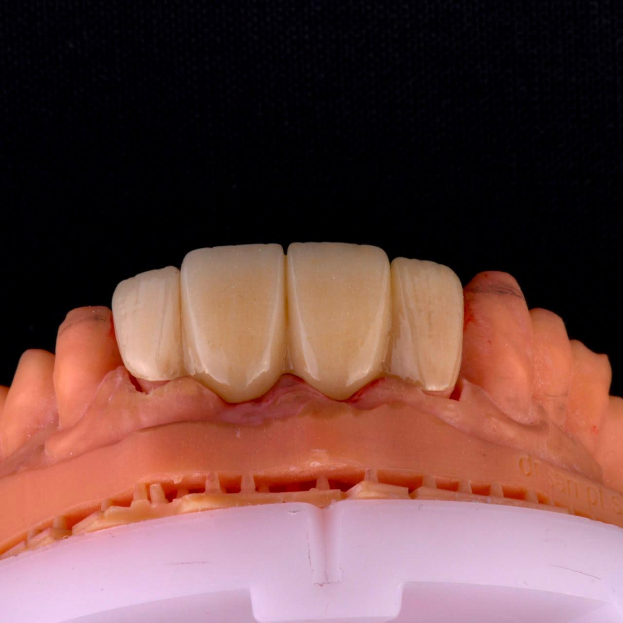 Dental ceramic case at Sari's Clinic