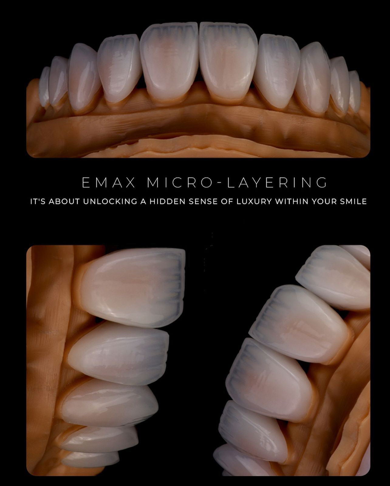 Emax micro-layering work at Sari's Clinic