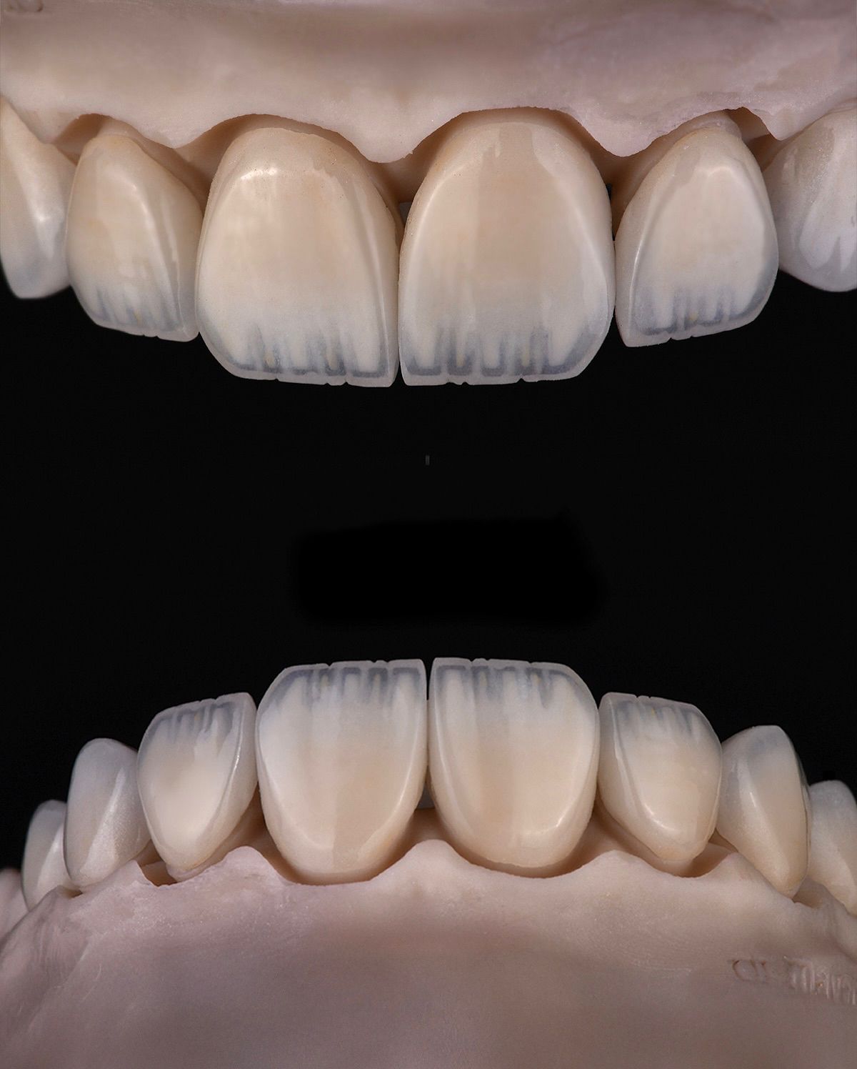 Full arch ceramic study at Sari's Clinic