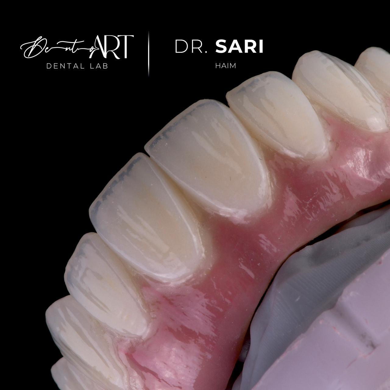 Gingival ceramic layering at Sari's Clinic