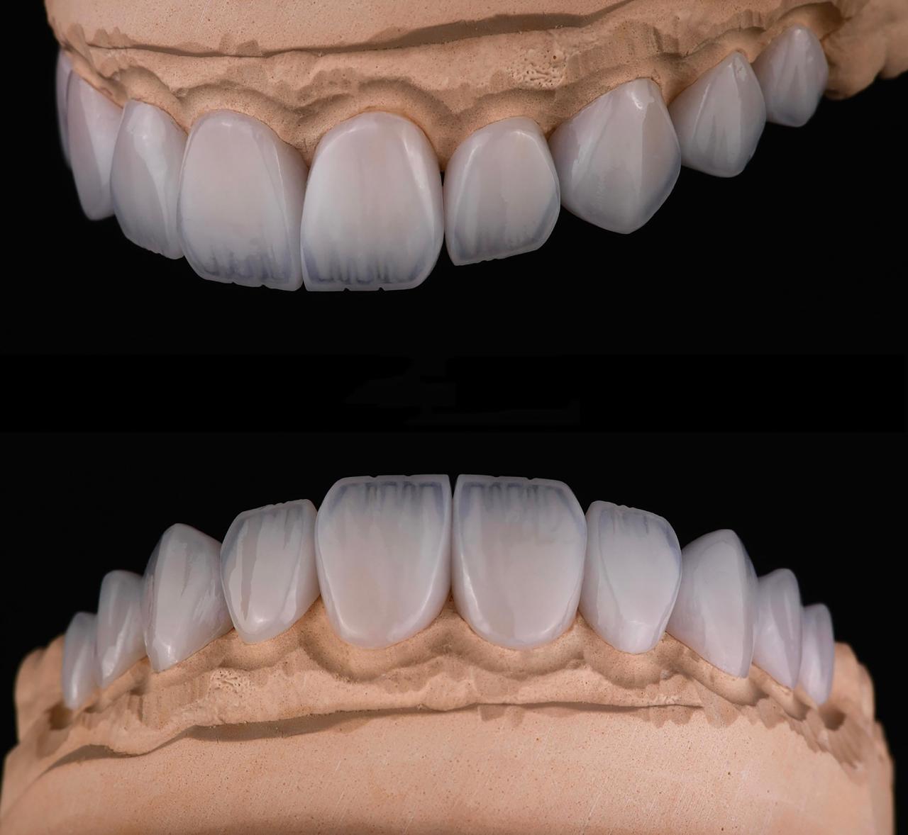 Veneer model study at Sari's Clinic