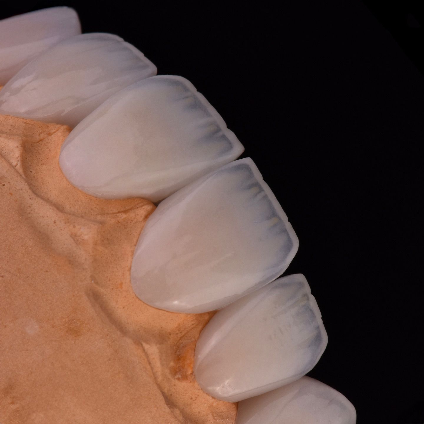 Veneers on master model at Sari's Clinic