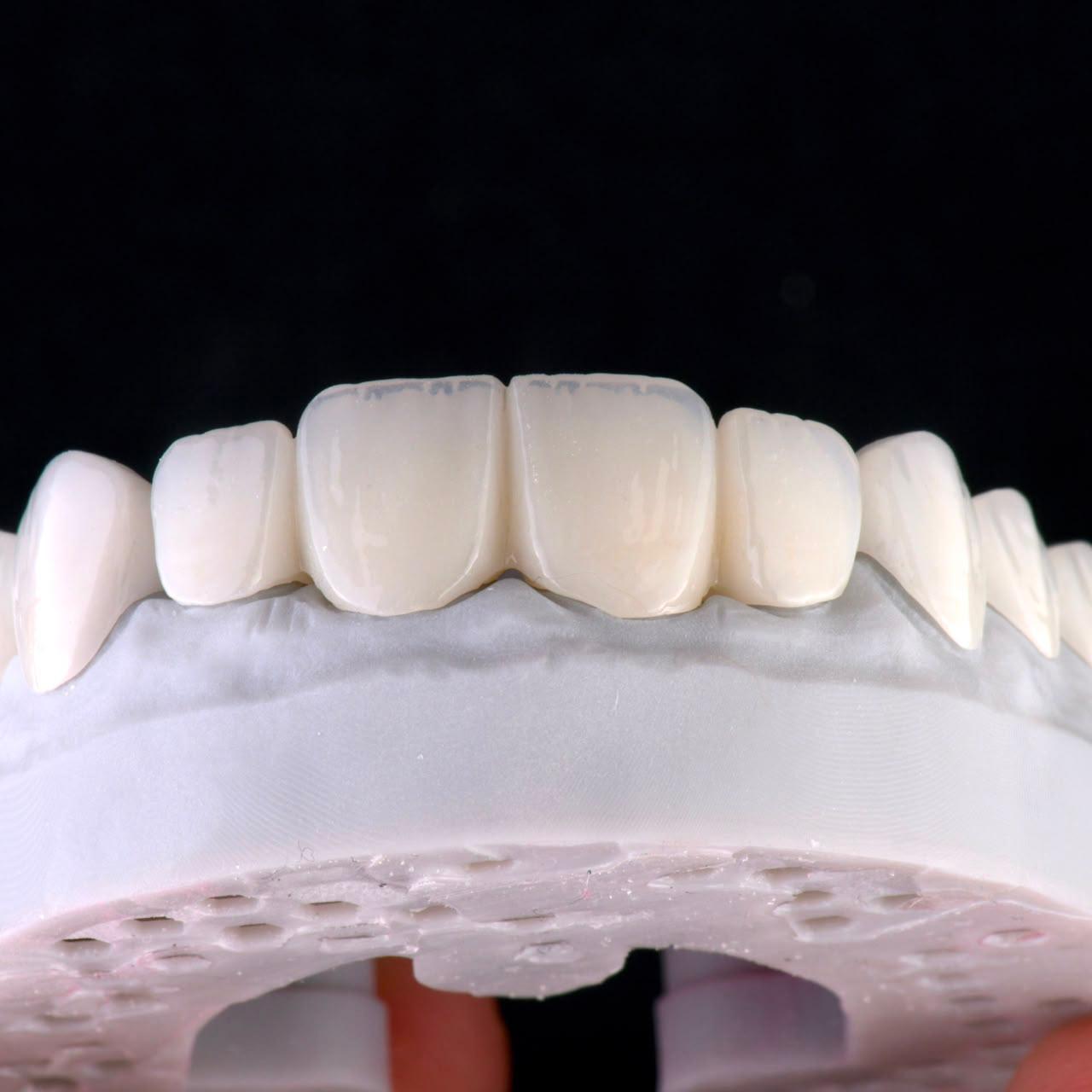Dental ceramic case at Sari's Clinic