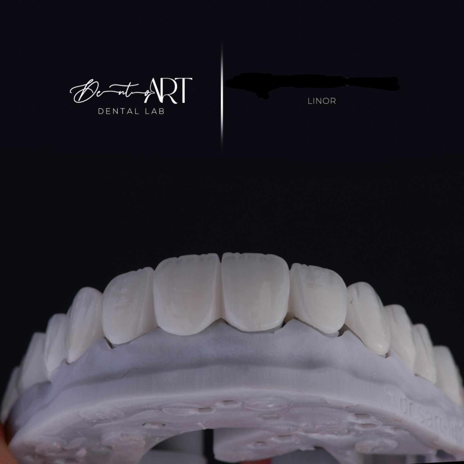 Veneer laboratory case at Sari's Clinic