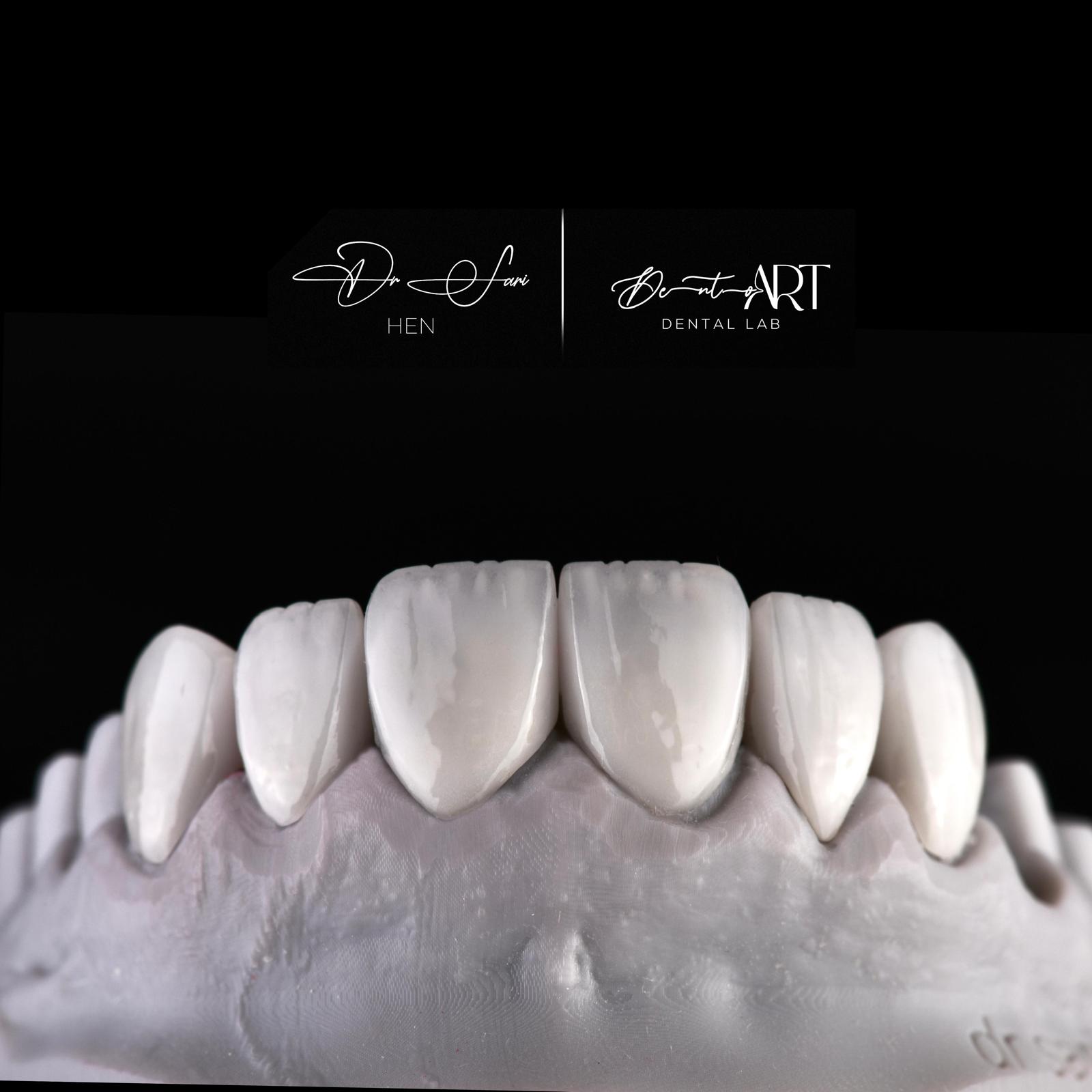 Laboratory veneer case at Sari's Clinic