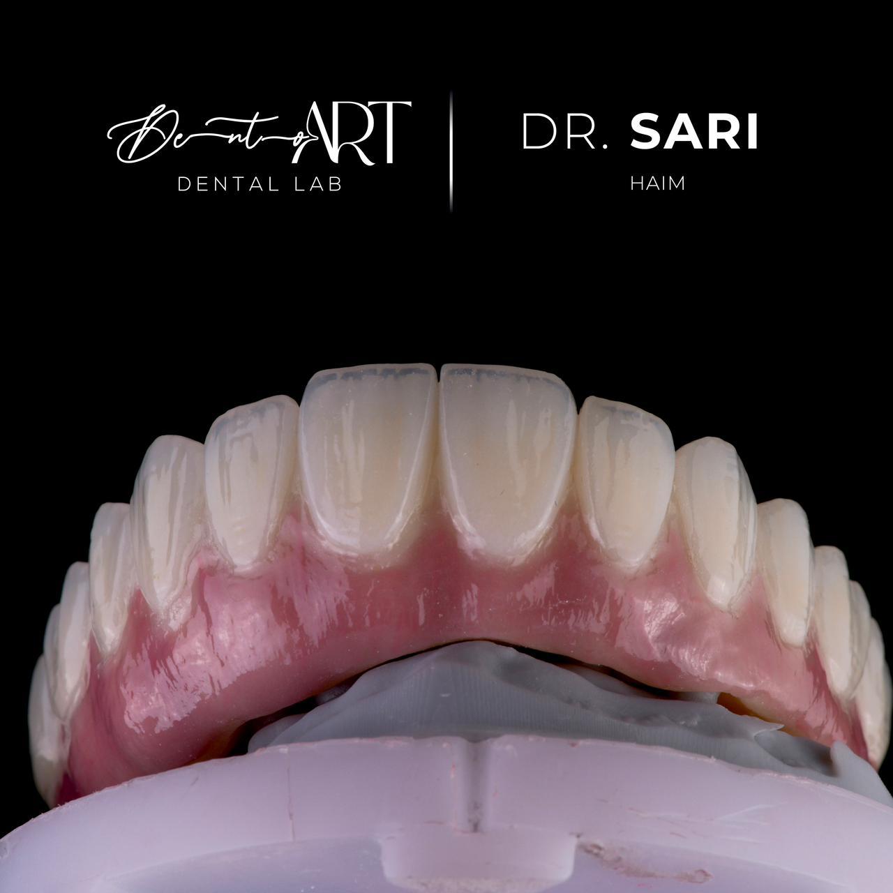 Full arch rehabilitation at Sari's Clinic