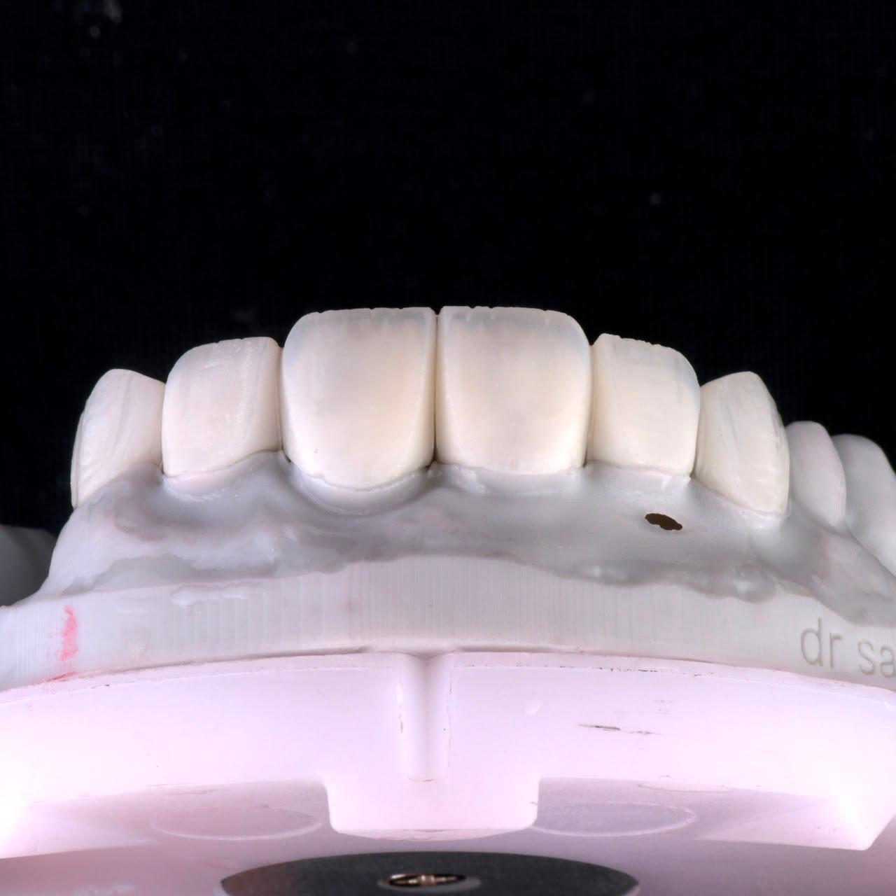 Dental ceramic case at Sari's Clinic