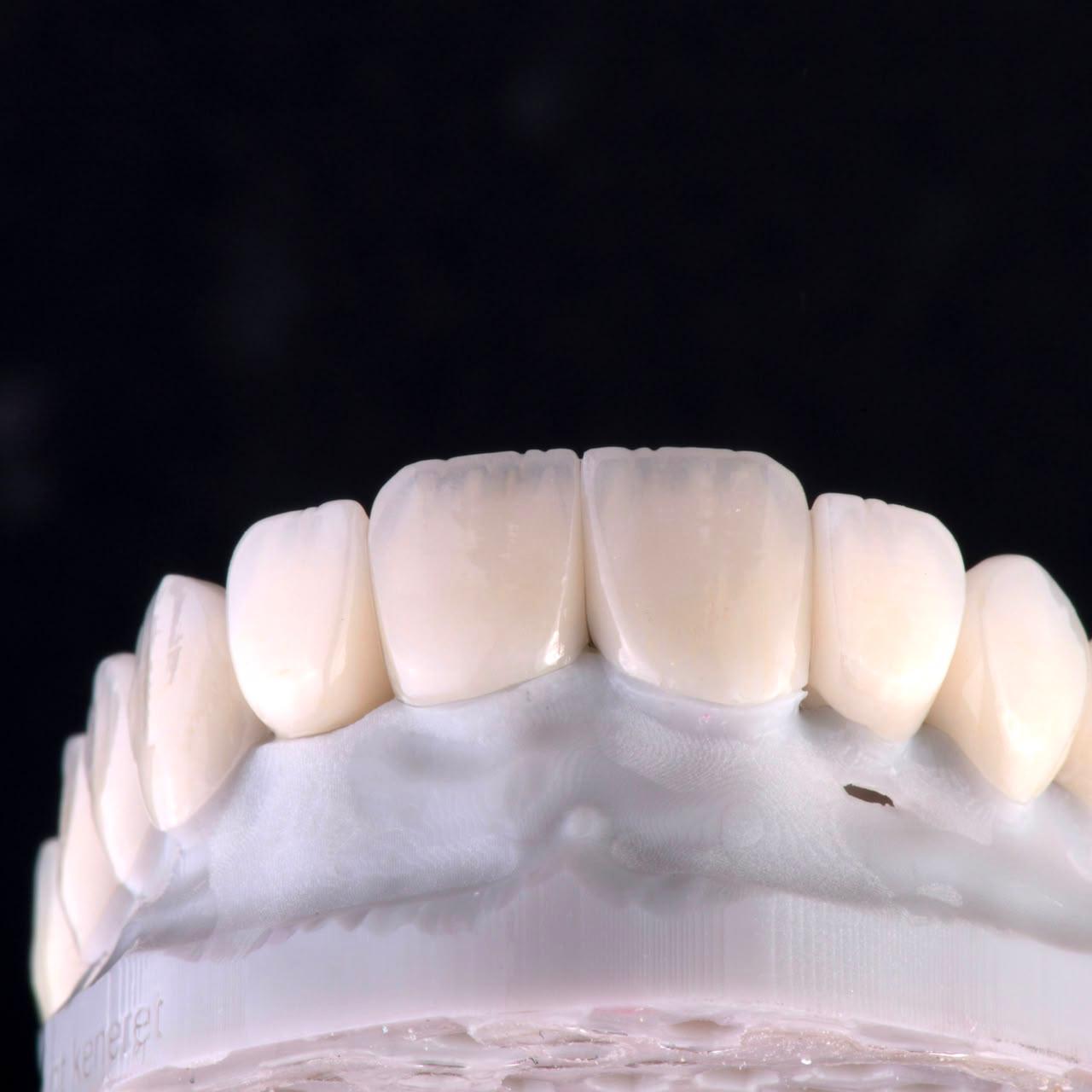 Dental ceramic case at Sari's Clinic