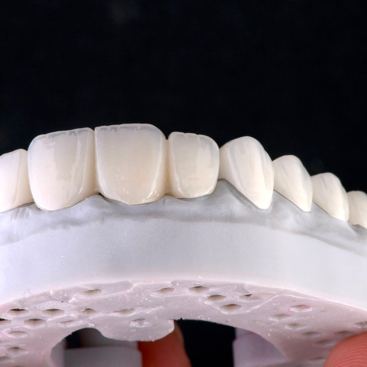 Dental ceramic case at Sari's Clinic