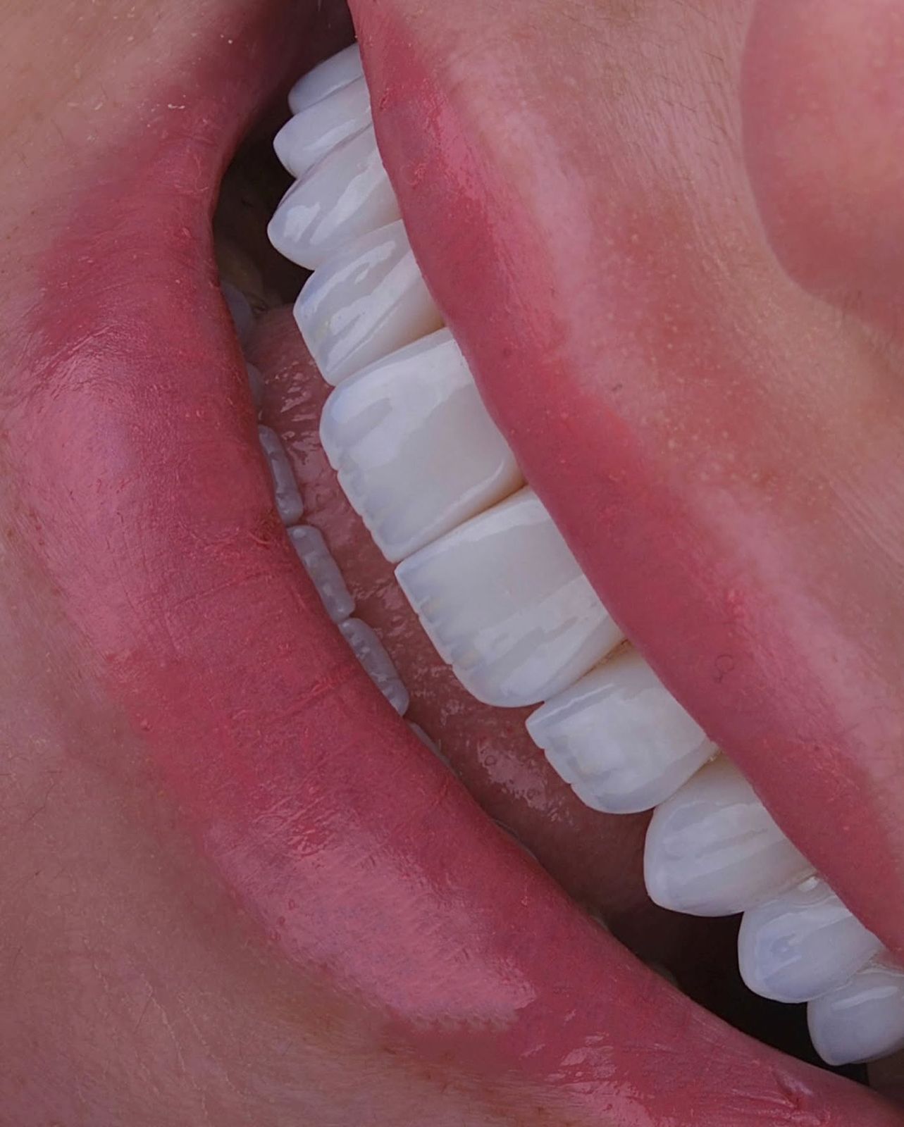 Bright veneer smile at Sari's Clinic