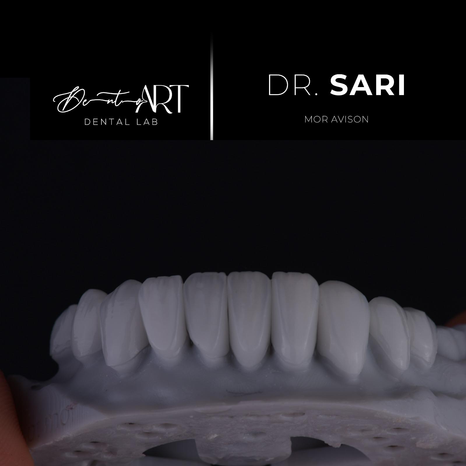 Veneer laboratory case at Sari's Clinic