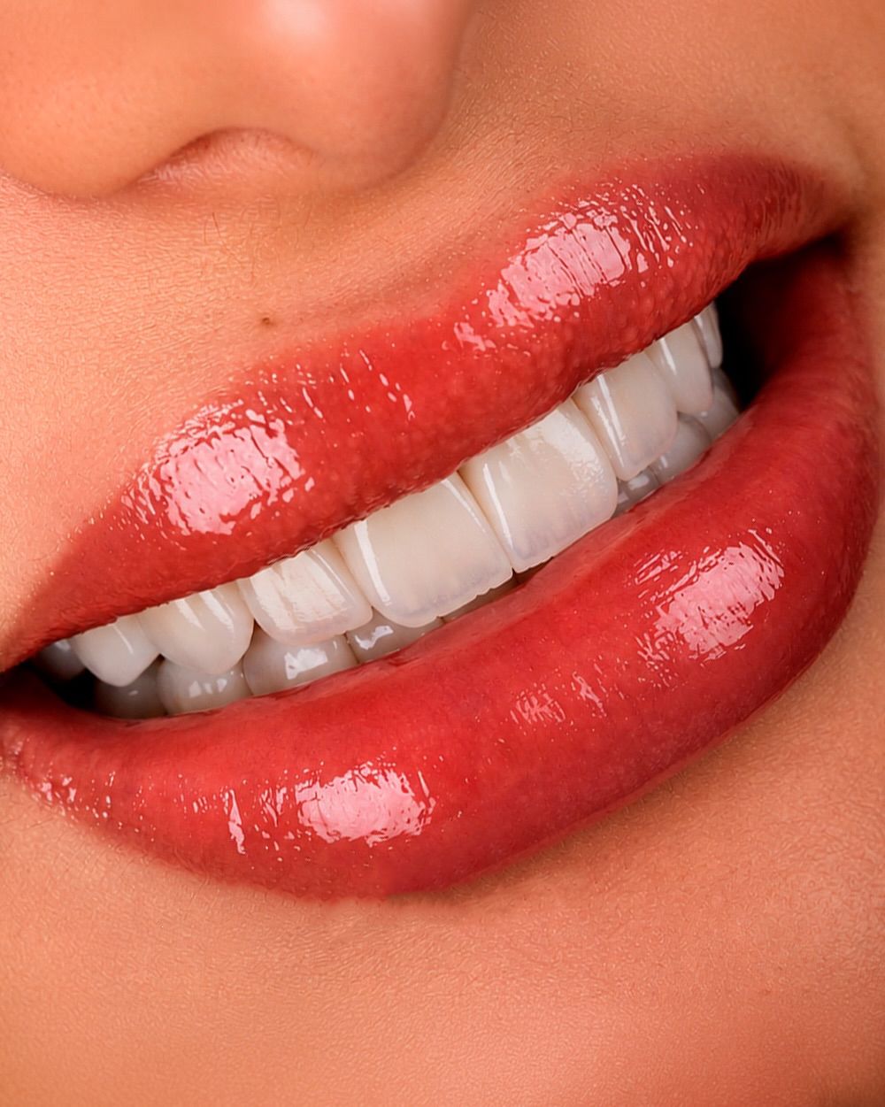 Aesthetic smile case at Sari's Clinic