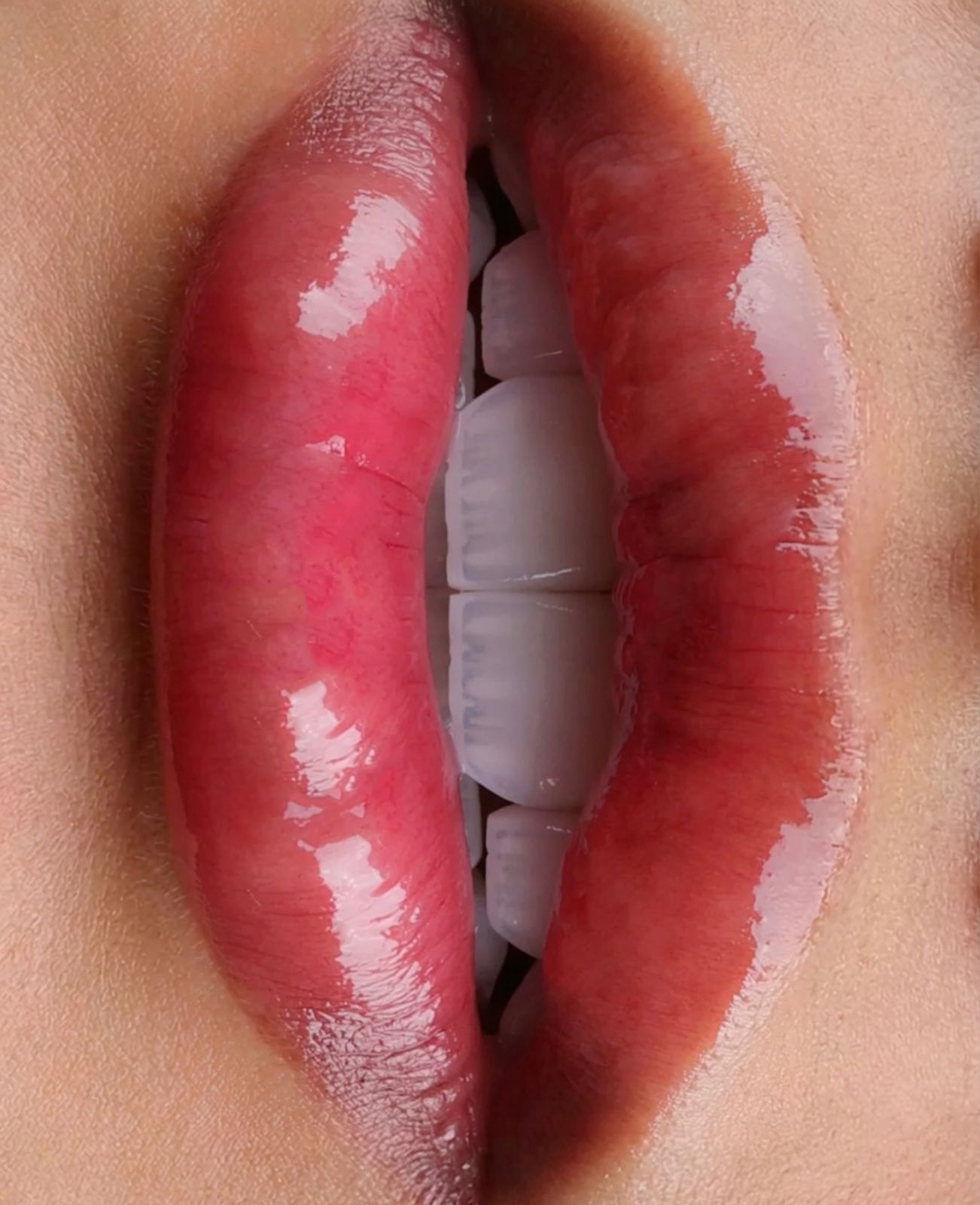 Glossy lips and porcelain veneers at Sari's Clinic