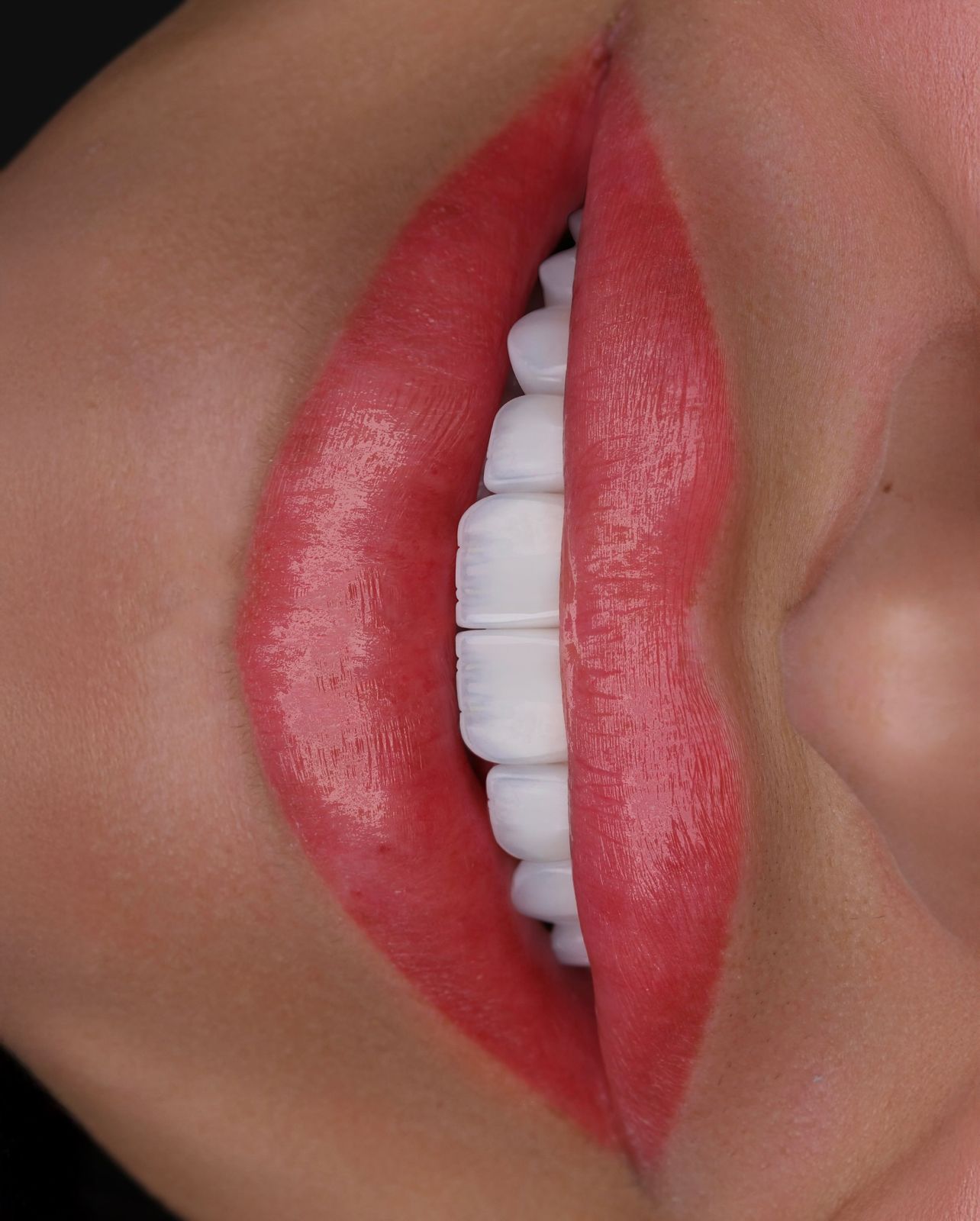 Coral lips with porcelain veneers at Sari's Clinic
