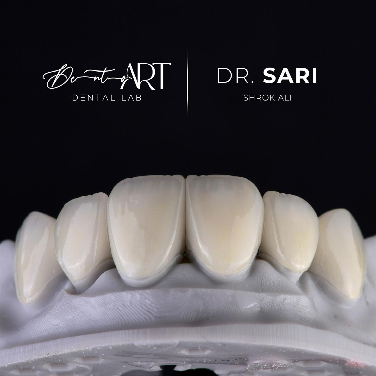 Custom crown case at Sari's Clinic
