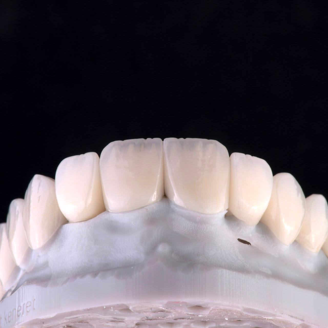 Dental ceramic case at Sari's Clinic