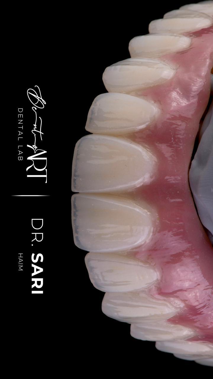 Implant supported prosthesis at Sari's Clinic