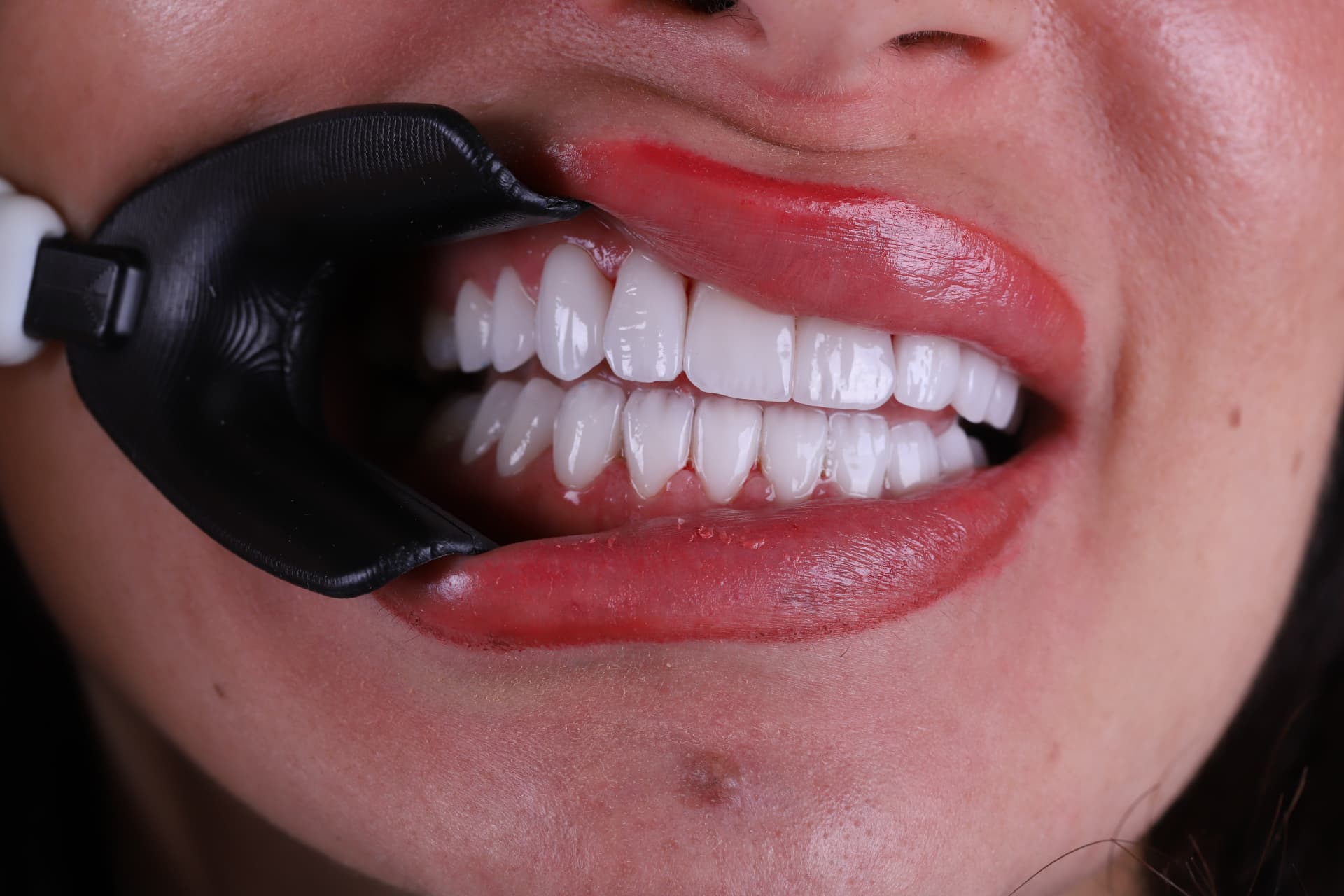 Whitening result at Sari's Clinic