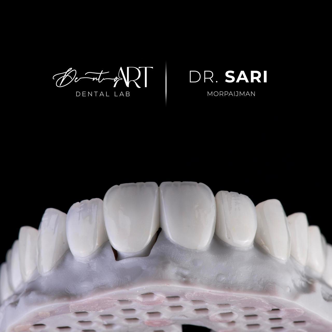 Anterior ceramic set at Sari's Clinic