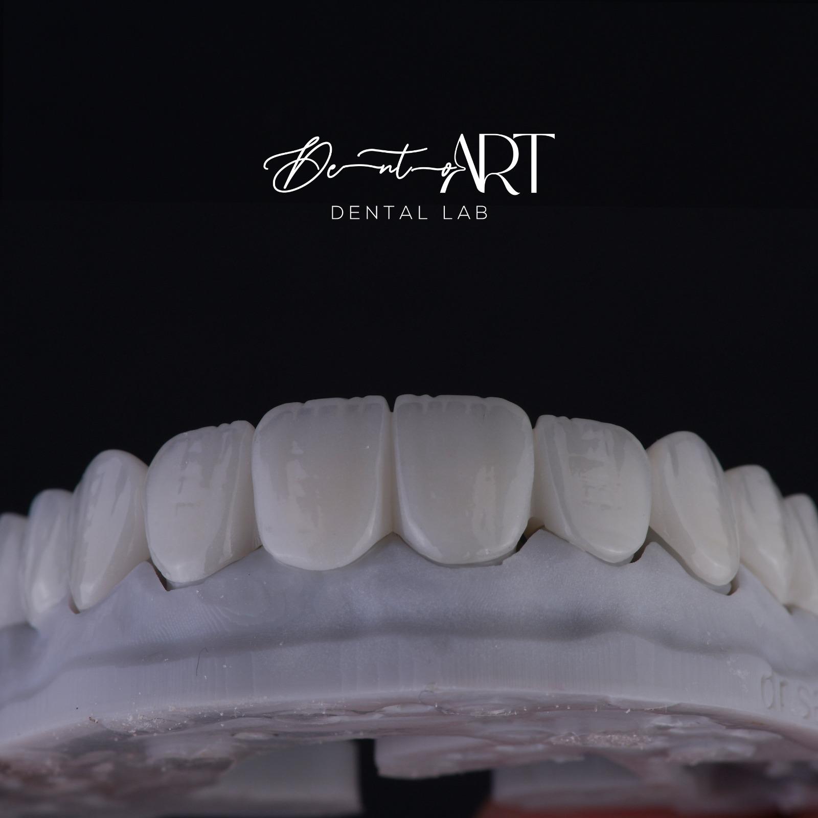 Veneer laboratory case at Sari's Clinic