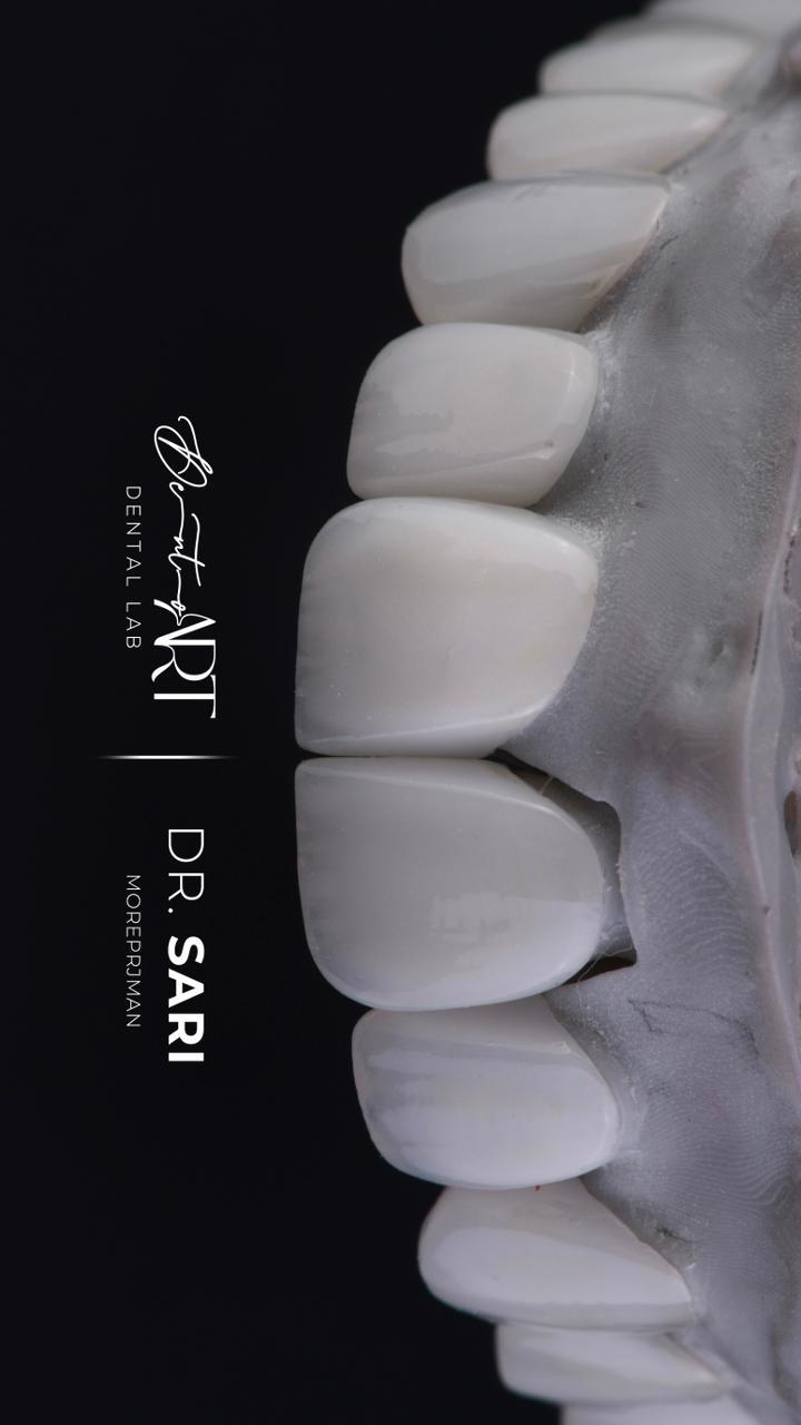 Veneer laboratory case at Sari's Clinic