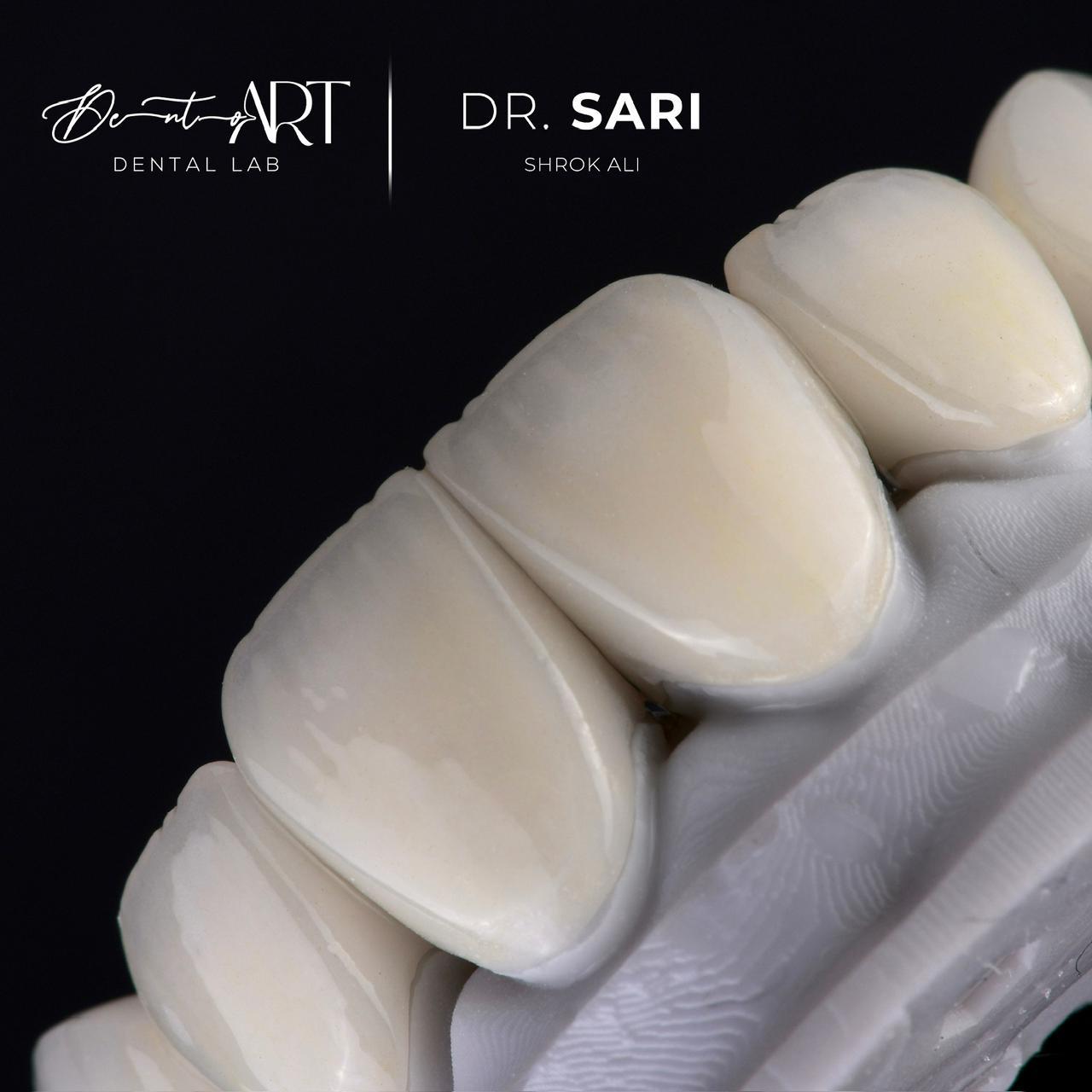 Veneer laboratory case at Sari's Clinic