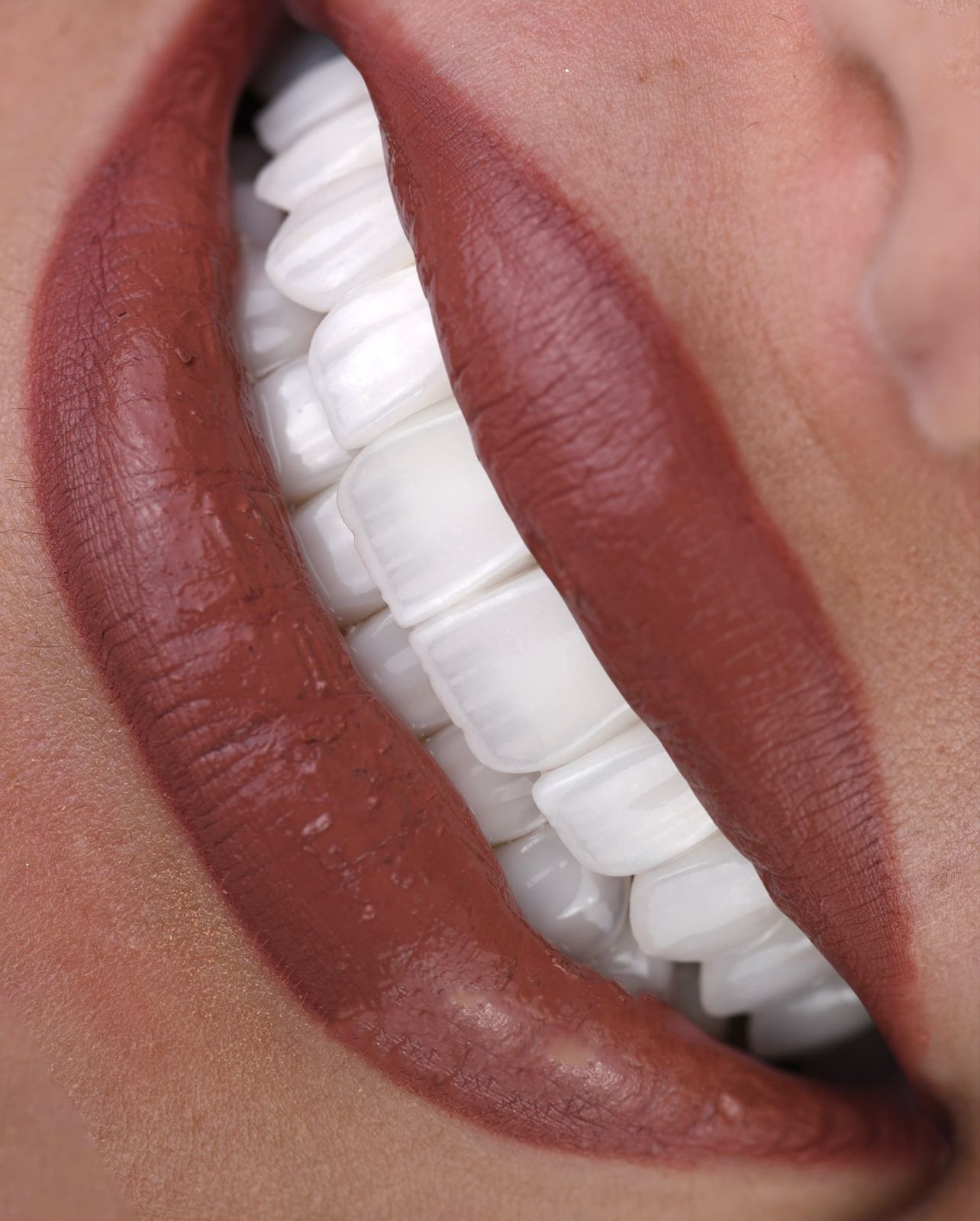 Porcelain veneer smile at Sari's Clinic