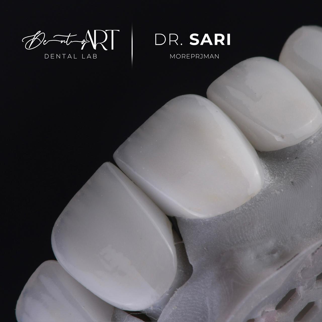 Veneer laboratory case at Sari's Clinic