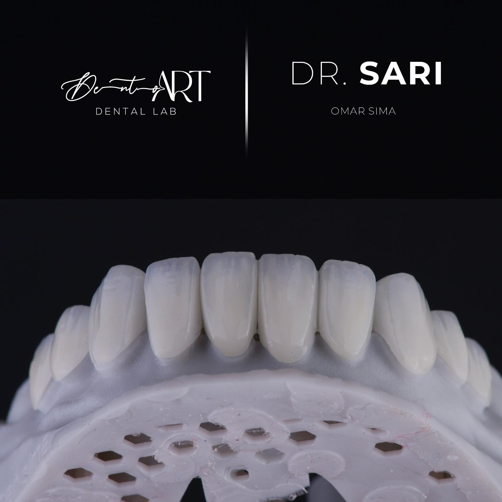 Veneer laboratory case at Sari's Clinic