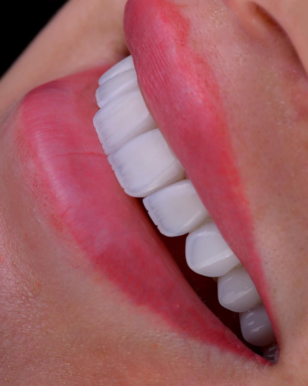 Bright smile result at Sari's Clinic