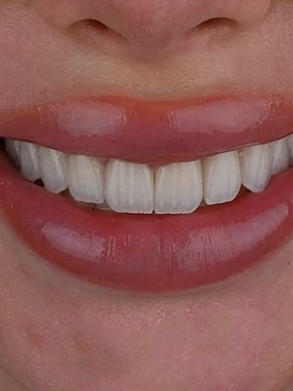 Natural smile line at Sari's Clinic