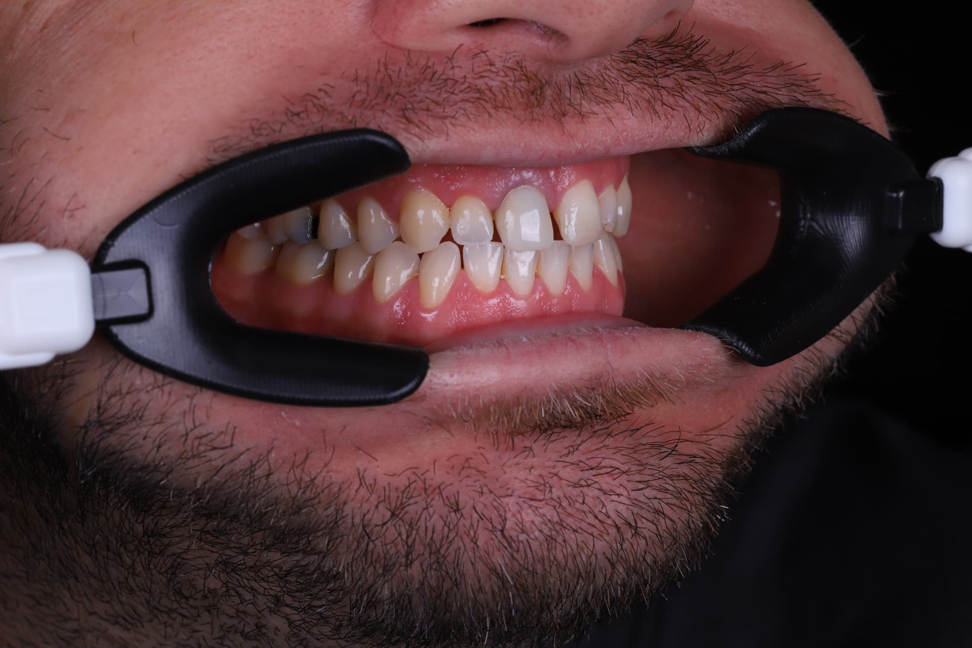 Smile design case at Sari's Clinic