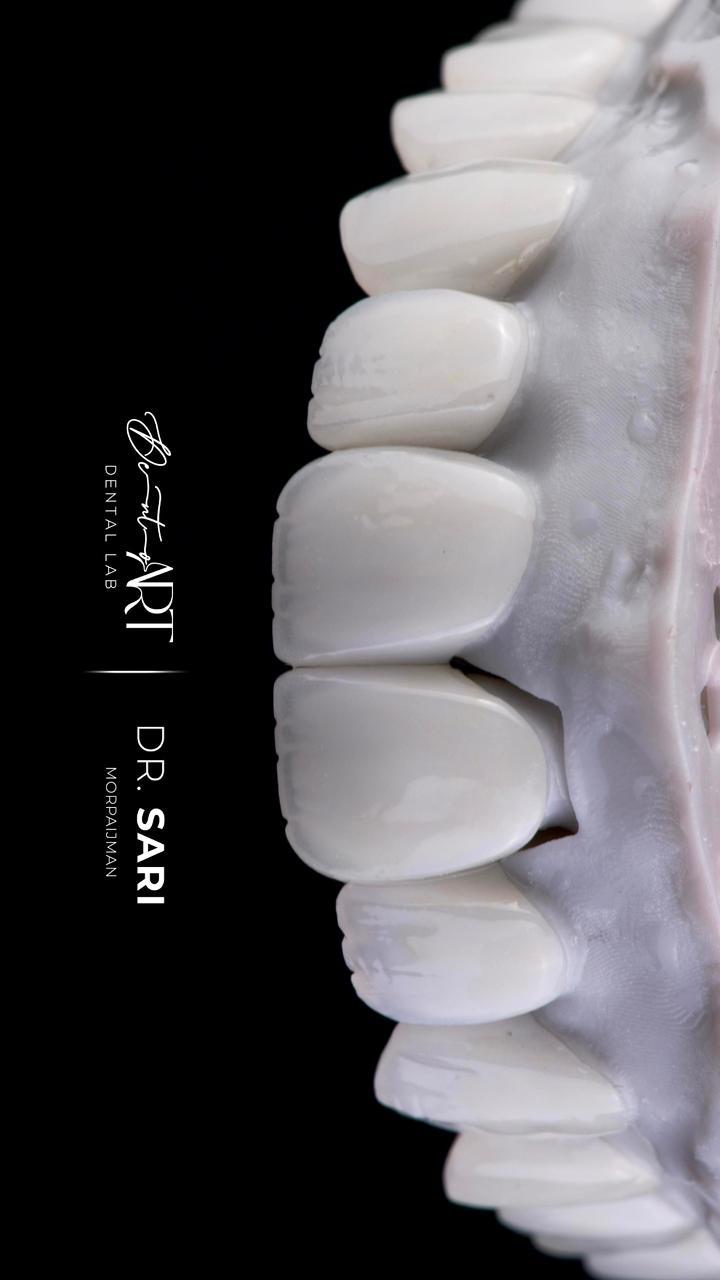 Veneer arch on model at Sari's Clinic