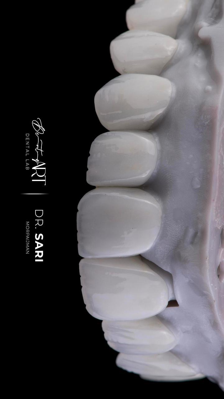 Lateral veneer profile at Sari's Clinic