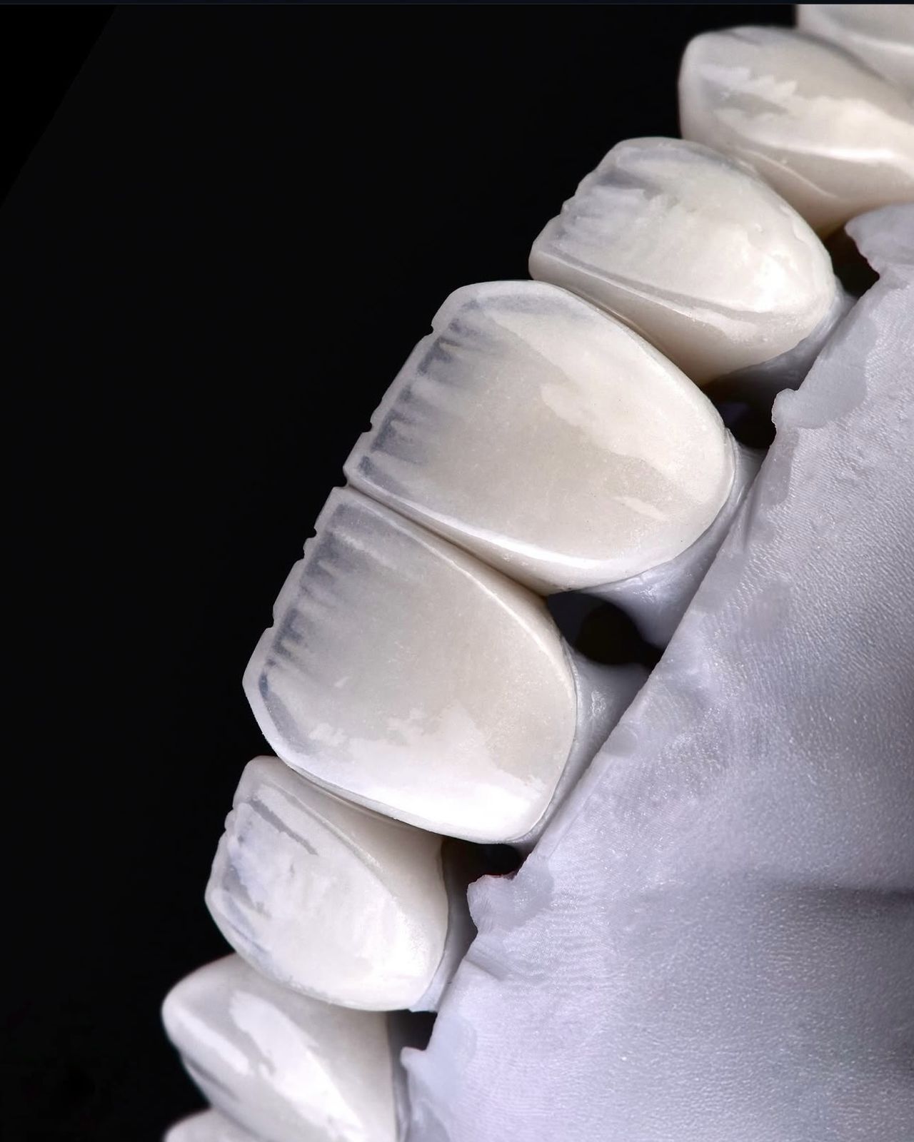 Layered ceramic veneers at Sari's Clinic