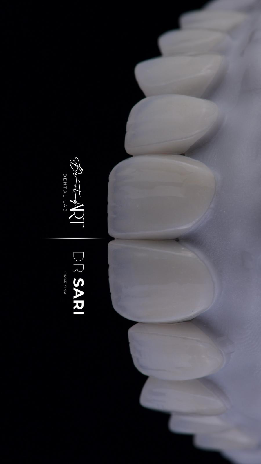 Veneer laboratory case at Sari's Clinic