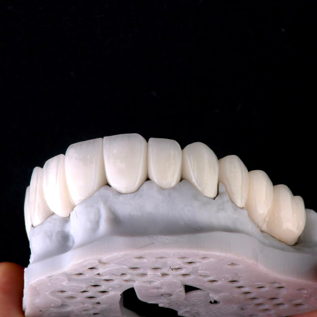 Dental ceramic case at Sari's Clinic