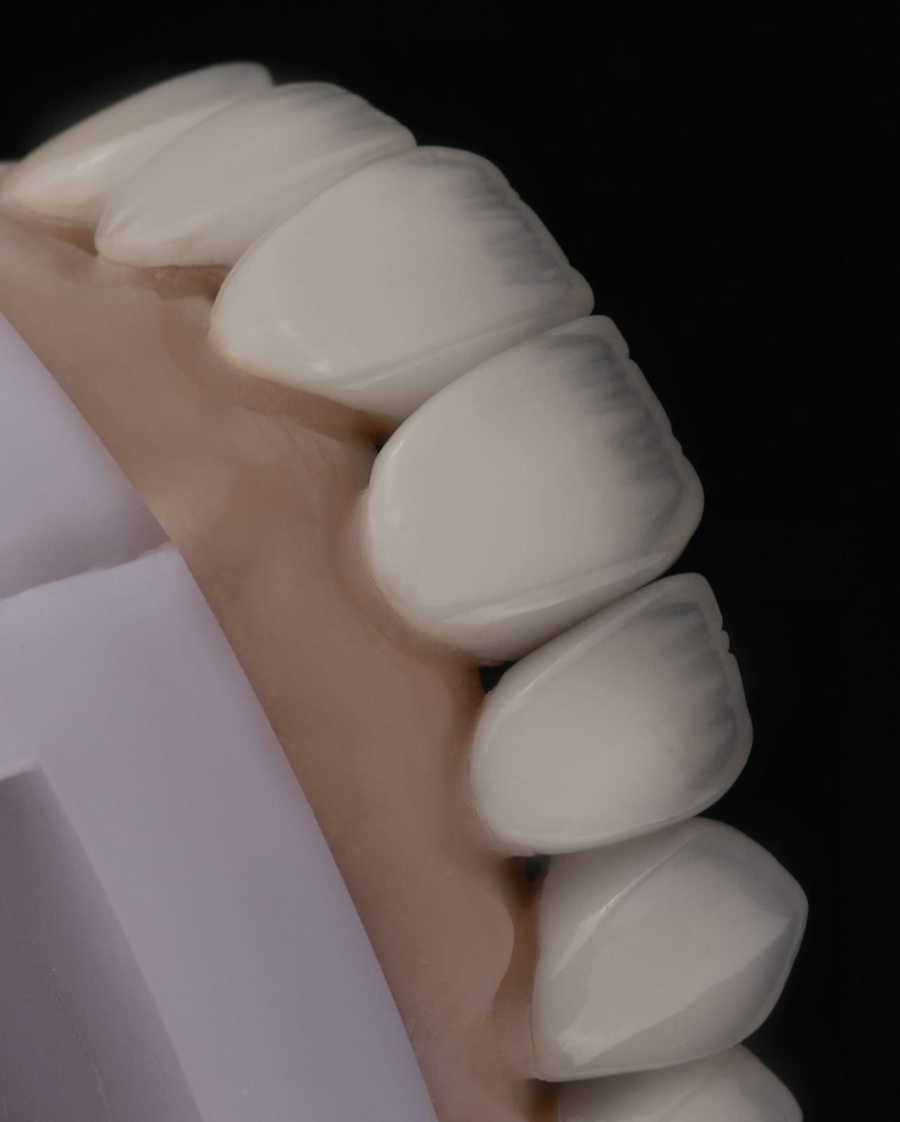 Side view of layered veneers at Sari's Clinic