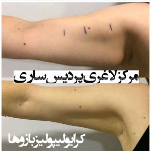 Patient7 https://sariclinic.com/wp-content/uploads/2022/09/لیپوماتیک-در-رشت-scaled.jpg